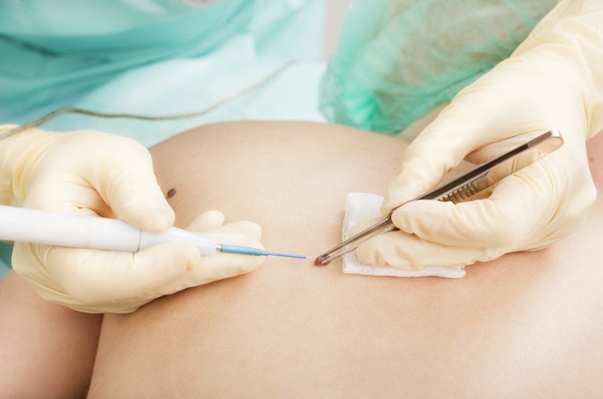 electrocautery Ciputra Medical Center