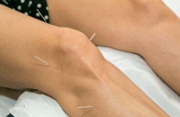 akupunktur mengobati radang sendi