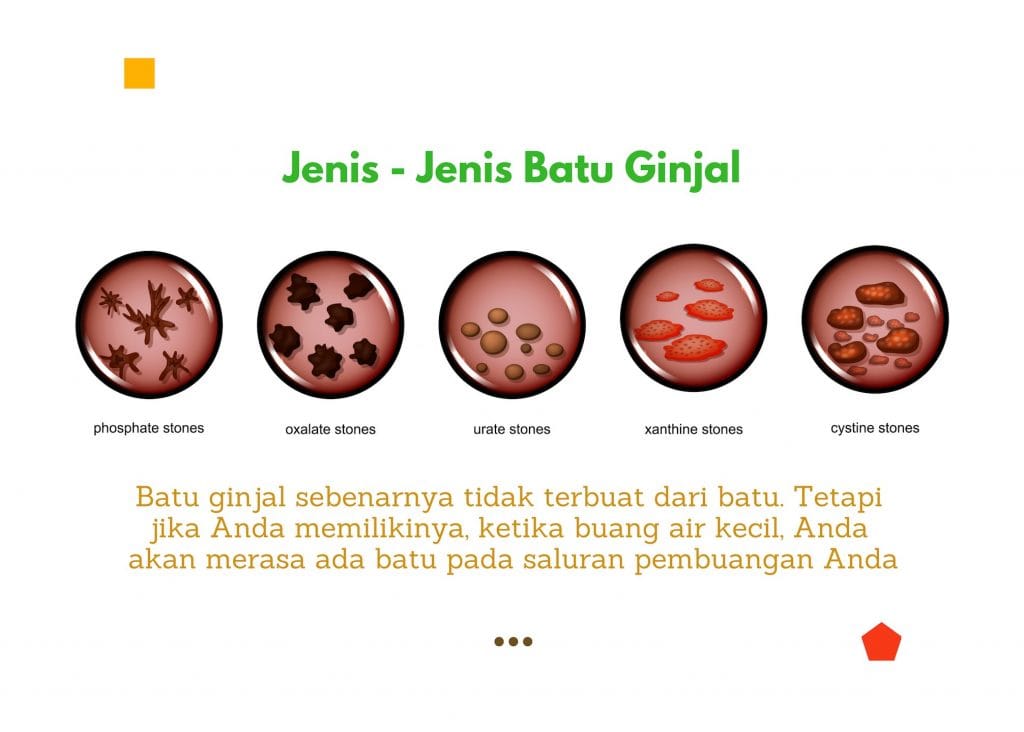 Batu Ginjal: Penyebab, Gejala, Diagnosa, Pencegahan