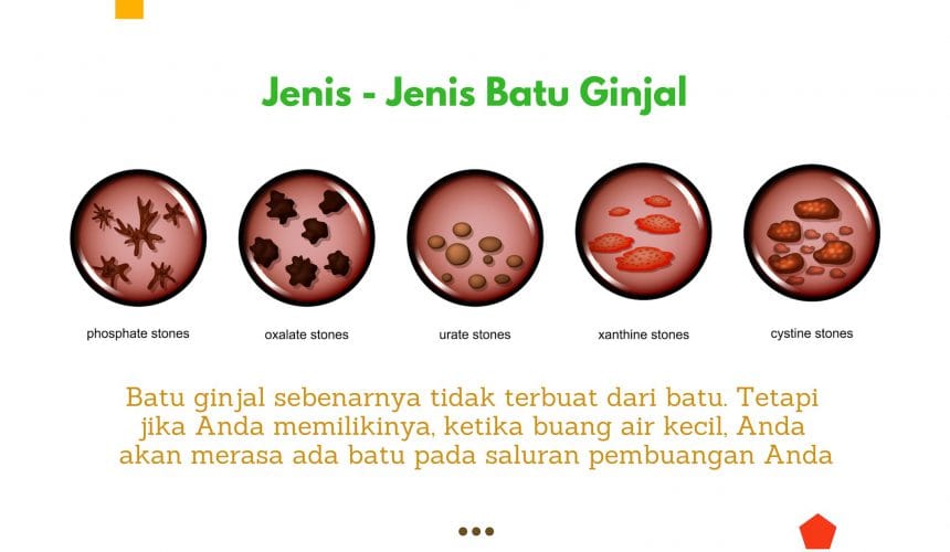 Batu Ginjal: Penyebab, Gejala, Diagnosa, Pencegahan Batu Ginjal: Penyebab, Gejala, Diagnosa, Pencegahan