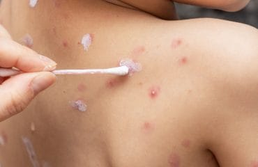 Pengobatan Cacar Air