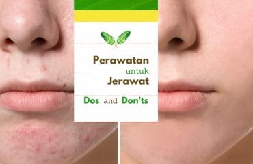 Perawatan Untuk Jerawat DOS and DON’TS