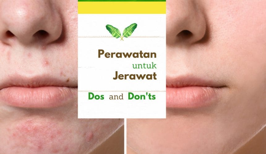 Perawatan Untuk Jerawat: DOS and DON’TS Perawatan Untuk Jerawat: DOS and DON’TS