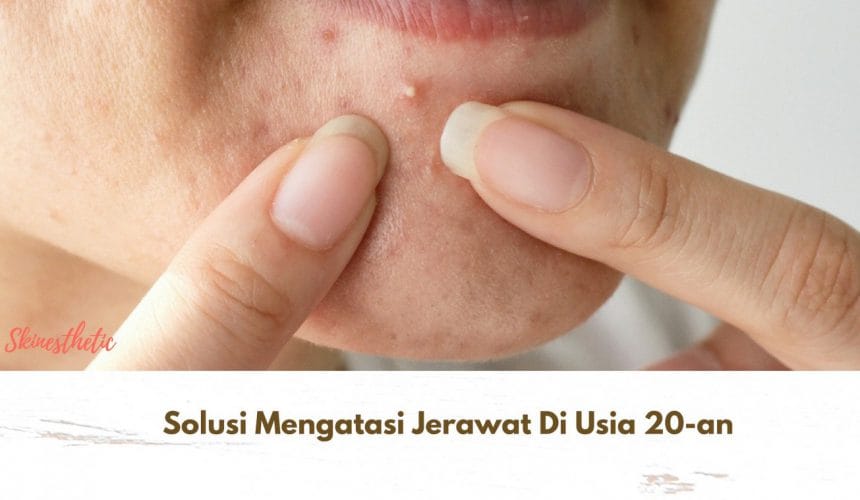 Solusi Mengatasi Jerawat Di Usia 20-an Solusi Mengatasi Jerawat Di Usia 20-an
