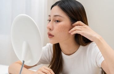 perawatan untuk jerawat