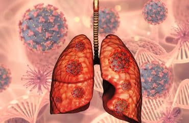 Penyebab Kanker Paru Bukan Hanya Rokok, Ini 11 Faktor Lain