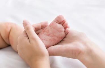 pantangan penyakit campak pada anak