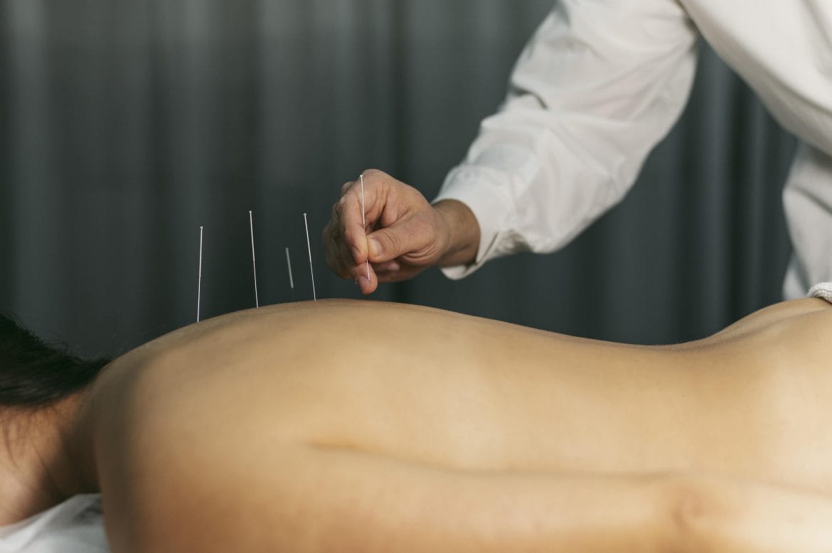 Dry Needling: Prosedur, Manfaat, dan Efek Sampingnya