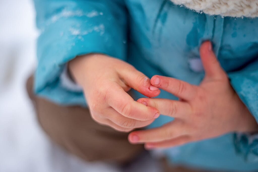 frostbite adalah