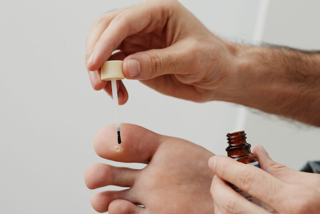 cara menghilangkan kutil di kaki