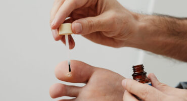 cara menghilangkan kutil di kaki