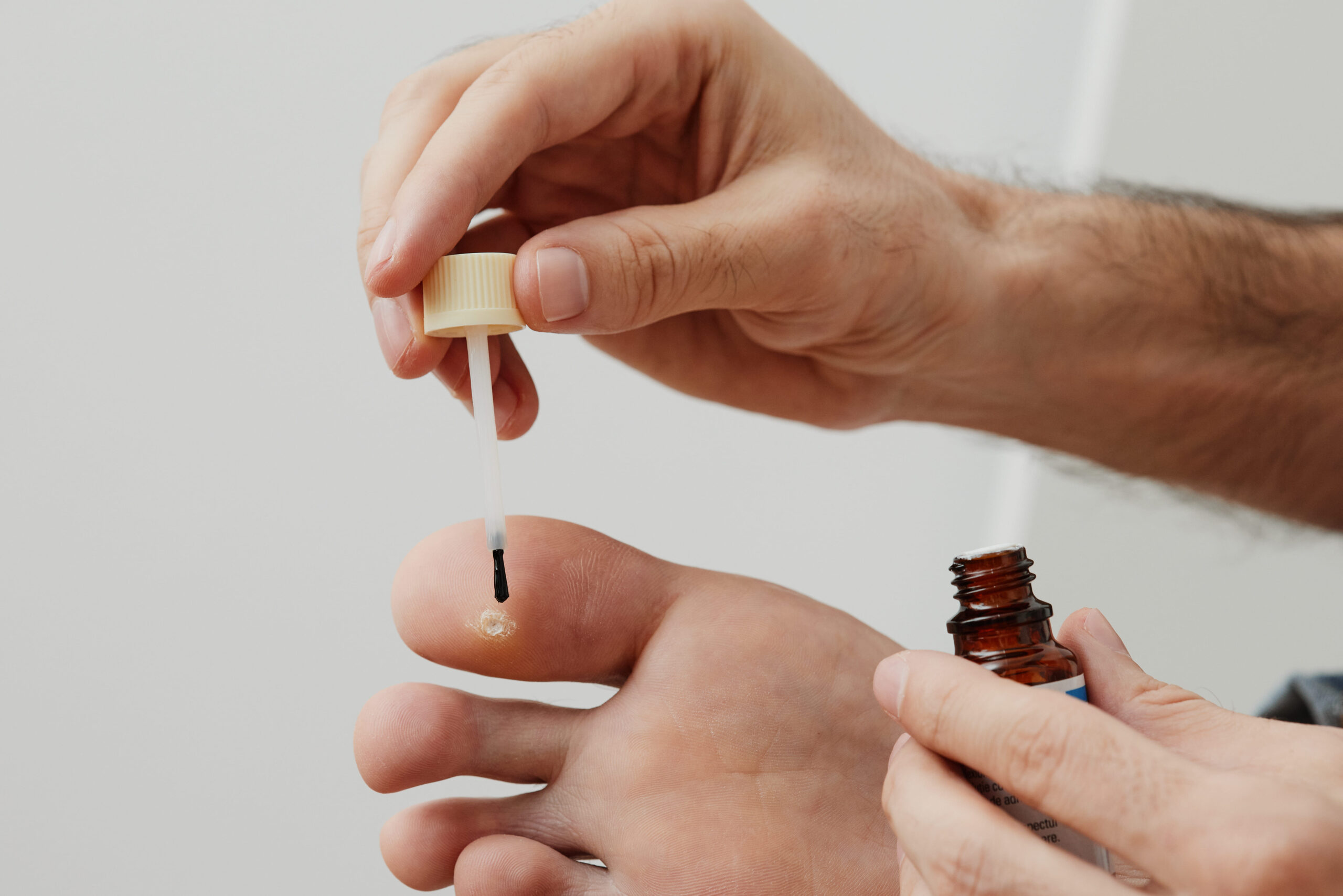 cara menghilangkan kutil di kaki cara menghilangkan kutil di kaki